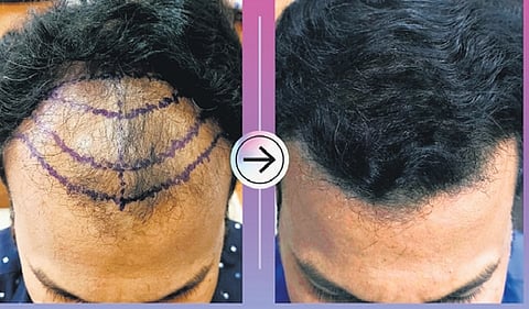 Hair transplantation done on a man.