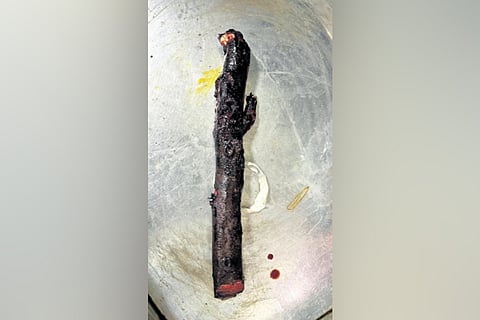 A team of doctors headed by him started operation at 9 pm and it took around four hours to remove the wooden stick and repair the injured organs and blood vessels very carefully. 