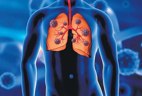 Cystic fibrosis is a genetic disease. 