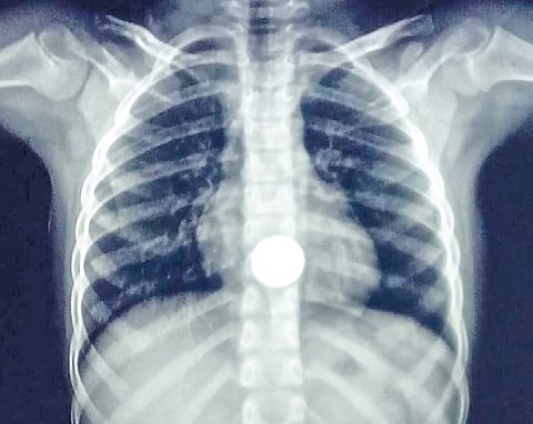 X-ray showing a five-rupee-coin lodged in the seven-year-old girl’s upper esophagus 