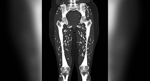  CT scan image of a patient with cysticercosis