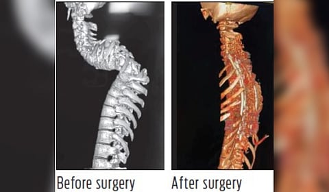 The procedure involved reconstructing the spinal column with titanium rods and cages. After a 14-hour surgery, the patient started walking within ten days. 