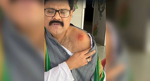 Congress leader  Ashwin Kumar Mahanta showing where he was “bitten”.