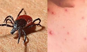 The illness is caused by the bacterium Orientia tsutsugamushi and spreads through the bite of infected chigger mites that thrive in tall grass, scrub forests, and dense vegetation.