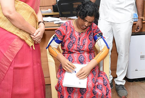 A 32-year-old woman native of Kotagiri in Nilgiris district lost her two hands up to elbows in an electrocution, was treated at Coimbatore Medical College Hospital and fixed customized prosthetic hands