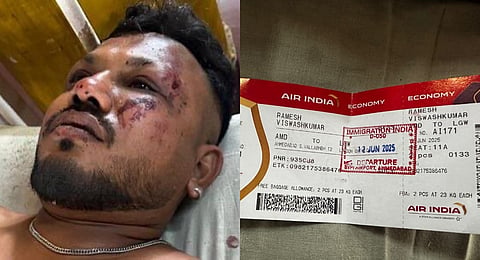 Vishwas Kumar Ramesh, the lone survivor of the Air India plane crash at Ahmedabad on 12 June, 2025. 