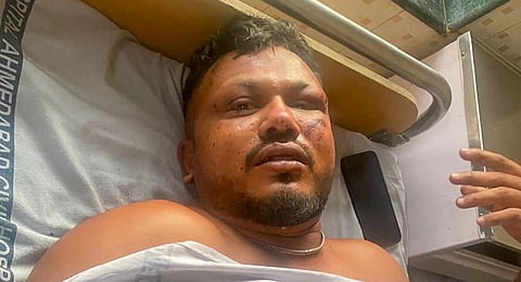 Vishwash Kumar Ramesh, the lone survivor of the Air India plane crash, receives treatment at a hospital in Ahmedabad, Thursday, June 12, 2025. 