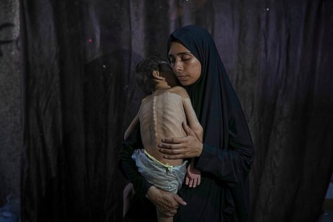 Samah Matar poses for a photo with her son Yousef, 6, who suffers from malnutrition and cerebral palsy, at a U.N.-run school in Gaza City, Saturday, July 26, 2025. In Gaza, malnutrition is often worsened by preexisting conditions and compounded by illnesses linked to inadequate health care and poor sanitation, largely the result of the ongoing war. 