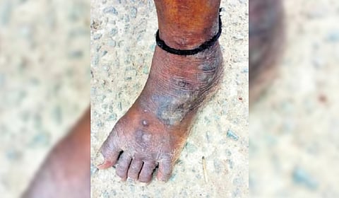Residents of Jawaharnagar suffer with skin allergies allegedly due to pollutants from the waste-to-energy plants. 