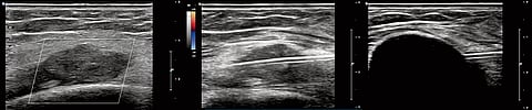MRI cryoablation is useful for managing small, early-stage cancers