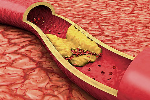 Manage cholesterol before it leads to heart attacks
