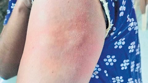 A person at the PMSSY Block shows the rash caused due to the bugs.
