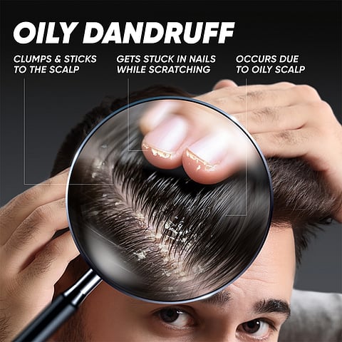 5 Signs Your Dandruff Needs More Than a Temporary Fix