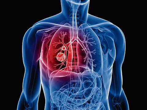 The bigger shifts under way in lung cancer care