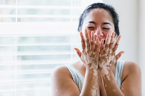 White patches on the skin: Is it vitiligo, a fungal infection, or something else? 