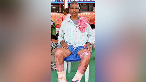 Rajesh Kumar Chowdhary, one of the injured workers, is still undergoing medical treatment