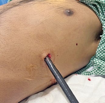 The arrow lodged in the patient’s chest