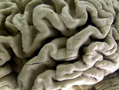 A human brain affected by Alzheimer’s disease is displayed at the Museum of Neuroanatomy at the University at Buffalo in Buffalo, N.Y., on Oct. 7, 2003.