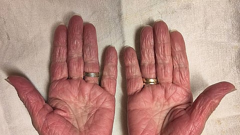 When Red Palms Signal Liver Trouble