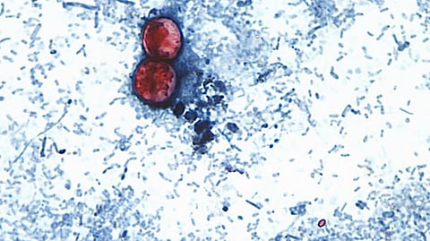 This undated photo taken through a microscope provided by the CDC shows Cyclospora cayetanensis oocysts found in a fresh stool sample which had been prepared with a formalin solution and stained with safranin. 
