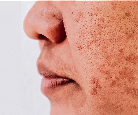 The Pigmentation Puzzle