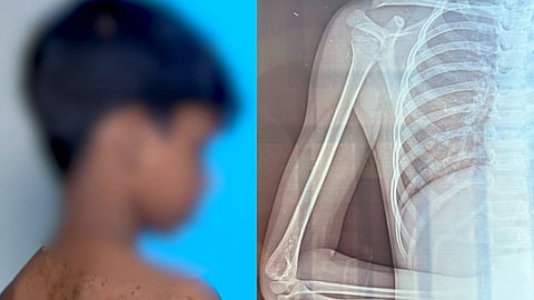 "ബോര്‍ഡിലുള്ളത് വേഗത്തില്‍ പകര്‍ത്തി എഴുതിയില്ല"; കണ്ണൂരിൽ രണ്ടാം ക്ലാസുകാരന്   ക്രൂരമർദനം