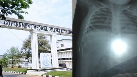ജനിച്ചപ്പോള്‍ ഉള്ളില്‍ കുടുങ്ങിയ സൂചിയുമായി കുഞ്ഞ് കഴിഞ്ഞത് ഒരു വര്‍ഷം! സ്വമേധയാ കേസെടുത്ത് ബാലാവകാശ കമ്മീഷൻ