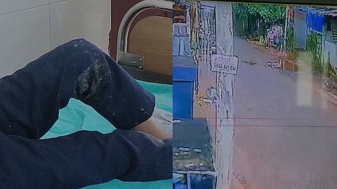 ലോറി തട്ടി മതില്‍ ഇടിഞ്ഞ് കുട്ടികള്‍ക്ക് മേല്‍ വീണു; അഞ്ചു പേർ ആശുപത്രിയിൽ
