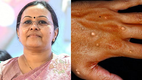 എംപോക്‌സ്: സംസ്ഥാനത്ത് ജാഗ്രത നിർദേശം പുറപ്പെടുവിച്ച് ആരോഗ്യവകുപ്പ്
