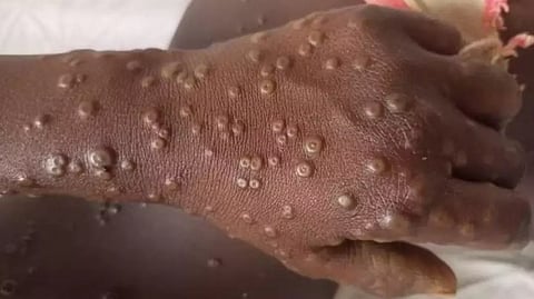 കണ്ണൂരിലും എംപോക്സ്? അബുദാബിയിൽ നിന്നെത്തിയ ആൾക്ക് രോഗലക്ഷണങ്ങൾ