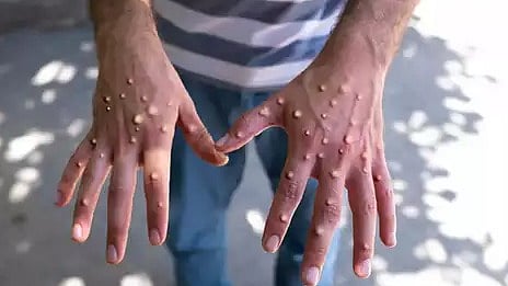 ആലപ്പുഴയിലും എംപോക്സ്? വിദേശത്ത് നിന്നെത്തിയ ആൾക്ക് രോഗലക്ഷണങ്ങൾ; കുടുംബം ക്വാറൻ്റൈനിൽ