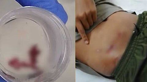 കോലഞ്ചേരി എംഒഎസ്‌സി മെഡിക്കല്‍ കോളേജില്‍ ചികിത്സാ പിഴവ്; അപ്പെന്‍ഡിസൈറ്റിസ് ശസ്ത്രക്രിയ നടത്തിയിട്ട് ബാക്കി ഭാഗം വയറില്‍ തന്നെ