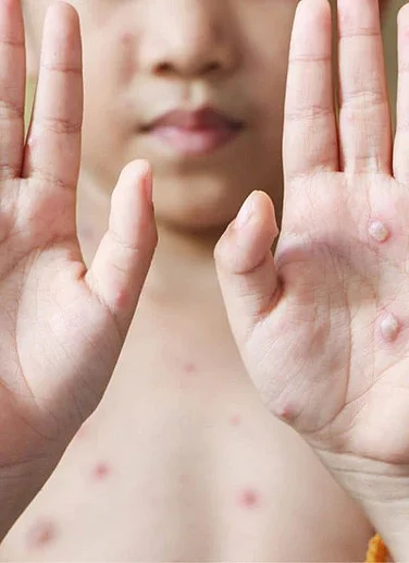 There Is A 'Tomato Flu' Outbreak In India - Here's What You Need To Know