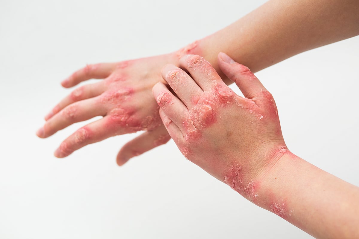 Psoriasis