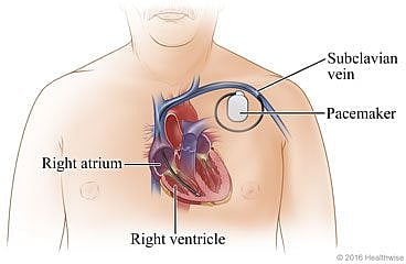 Pacemaker devices fitted in the chest after surgery.