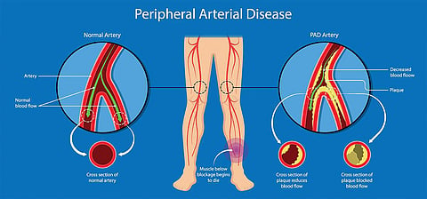 peripheral artery disease