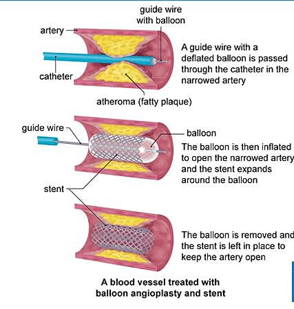 A blood vessel treated with balloon angioplasty and stent