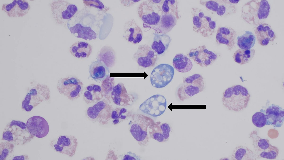 High resolution image of the amoeba found in cerebrospinal fluid sample. - CDC