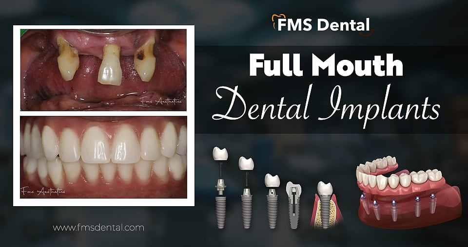 Implant Dentistry