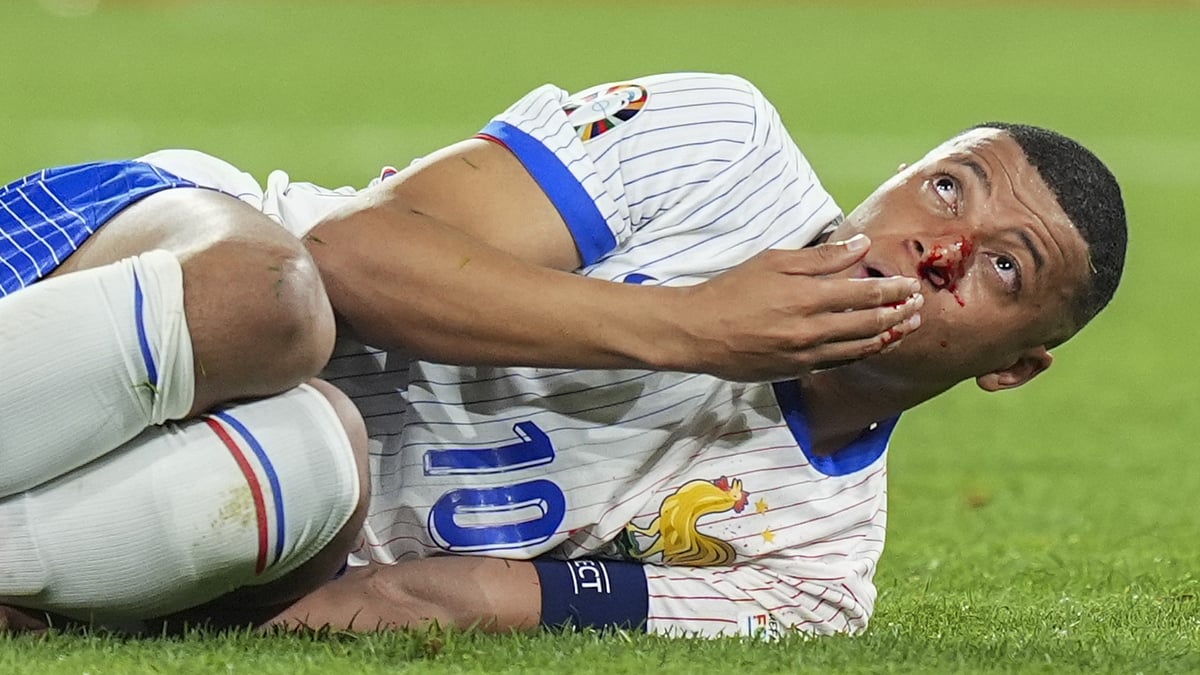 Kylian Mbappe sustained a late nose injury on Monday
