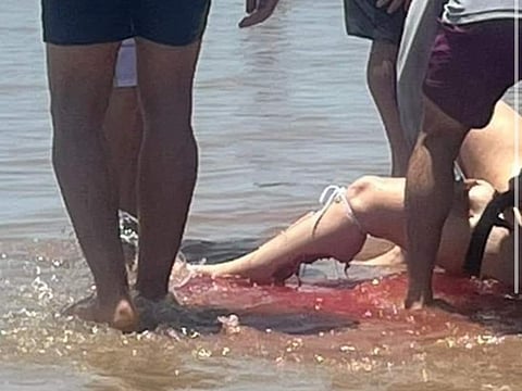 Woman attacked by shark.