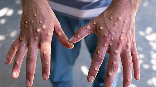 X/@gvmmanoj : Mpox outbreak 