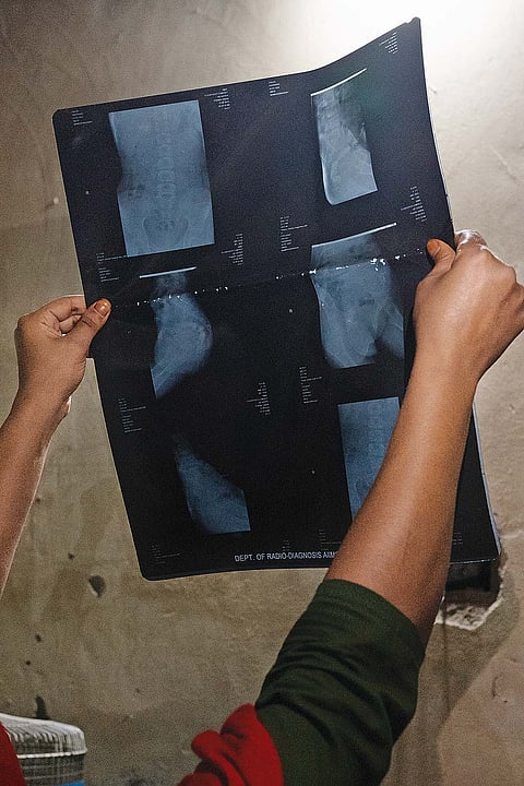 X-rays of Shabnam’s injuries
