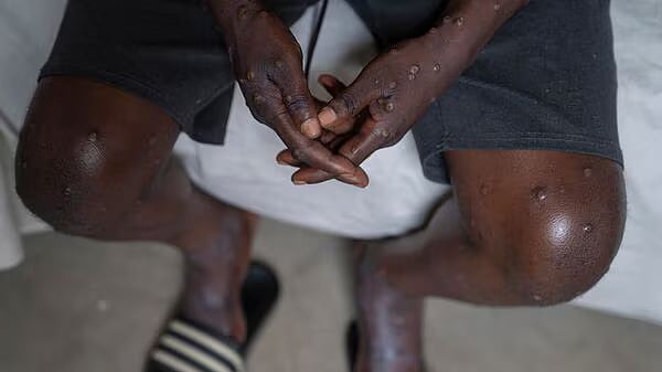 AP : Mpox outbreak in Africa