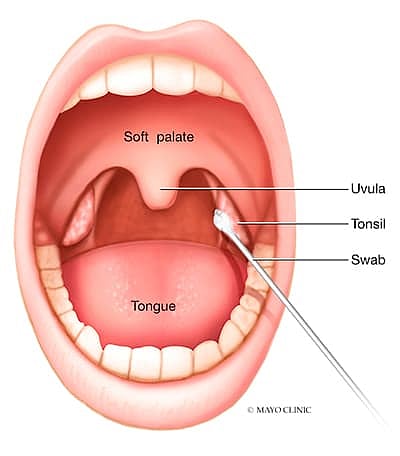 Throat Infection