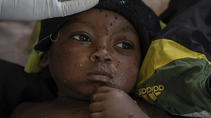 Mpox congo kamituga
