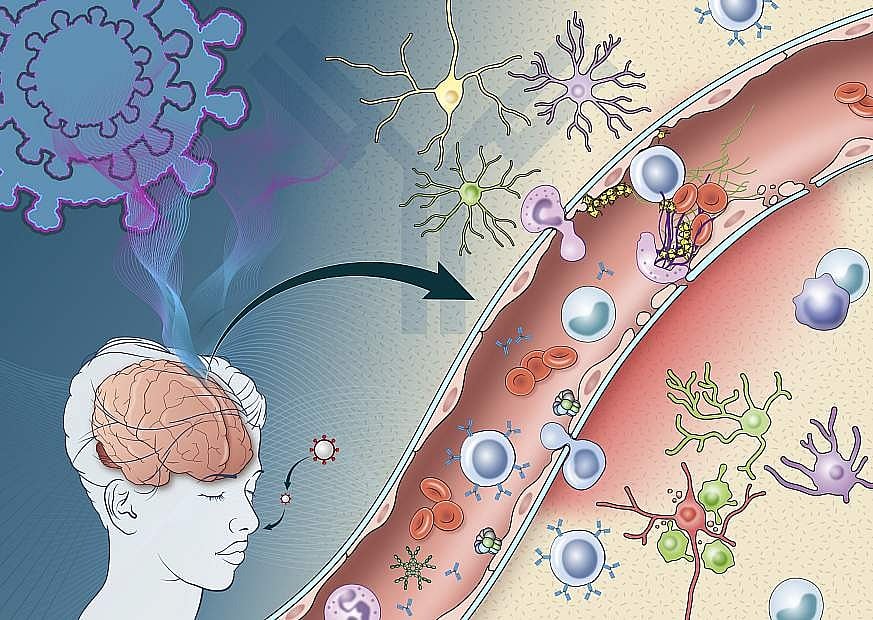 Brain Inflammation Could Explain Long COVID Symptoms: Study