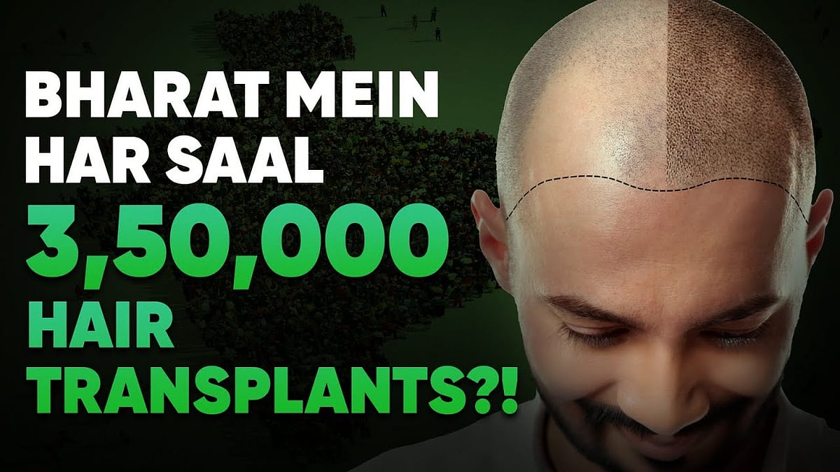 Hair Transplant Ka Sach: Kya Yeh Hair Loss Ka Asli Solution Hai?