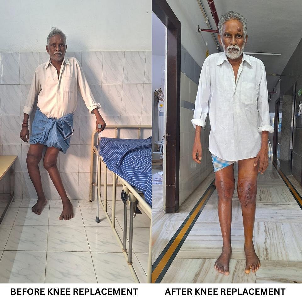 Knee Replacemetn 