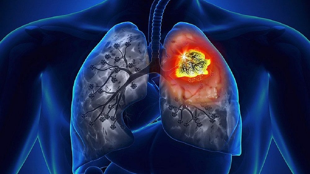 Representational Image : Age-wise, the highest number of cases was reported in the 60–80 year group, with 4,234 patients, followed by 3,669 cases in the 40–60 year bracket.